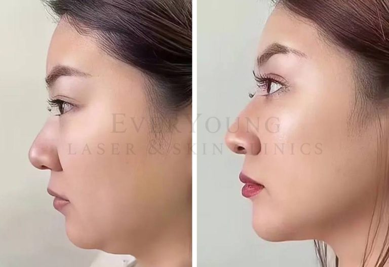 Fat Dissolve + Jawline Filler