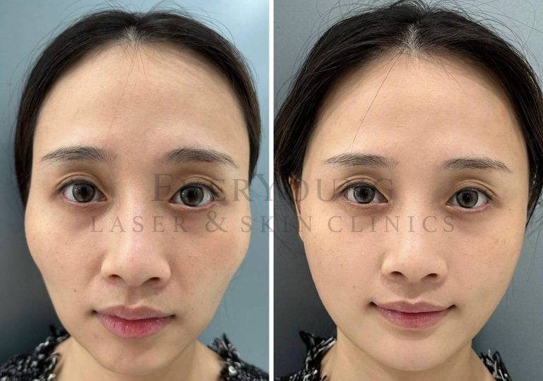 Fillers - Full Face Transformation | EverYoung Laser & Skin Clinic