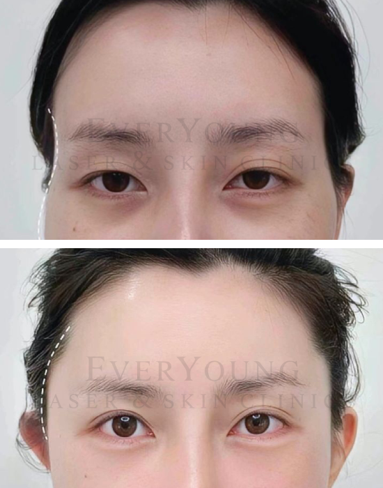 Temple Fillers - Before & After Treatment | EverYoung Laser & Skin Clinic