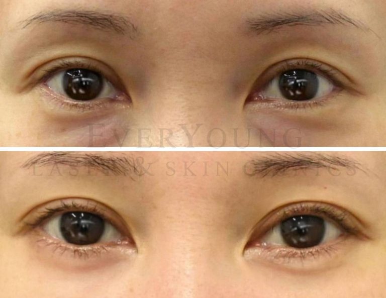 Under Eye Fillers - Before & After | EverYoung Laser & Skin Clinic