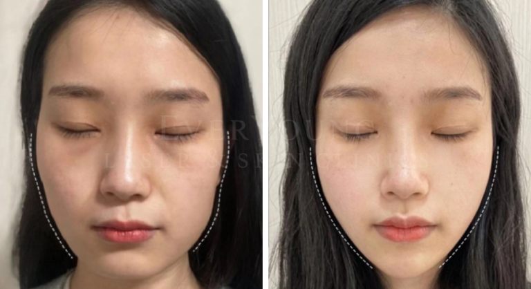 Filler & Botox Face Slimming - Before & After Treatment | EverYoung Laser & Skin Clinic