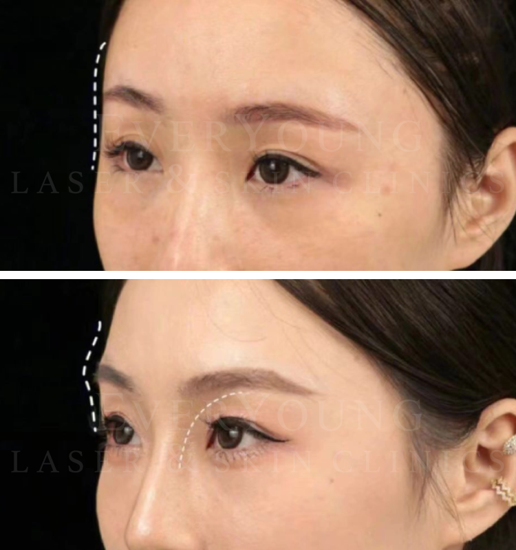 Fillers - Before & After Treatment | EverYoung Laser & Skin Clinic