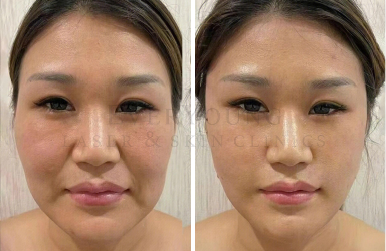 Filler & Thread Lift Treatment | EverYoung Laser & Skin Clinic