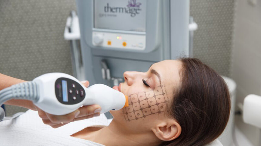 Thermage® CPT™ Skin Tightening in Vancouver 2 Thermage® CPT™ Skin Tightening Vancouver | EverYoung