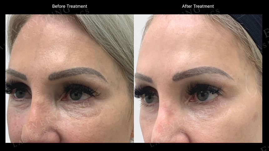 Thermage® FLX Skin Tightening in Vancouver 13 thermage flx undereyes treatment