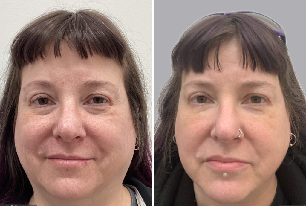 Thermage® CPT™ Skin Tightening in Vancouver 13 Using Thermage® CPT™ Before & After Results | EverYoung Skin Clinic