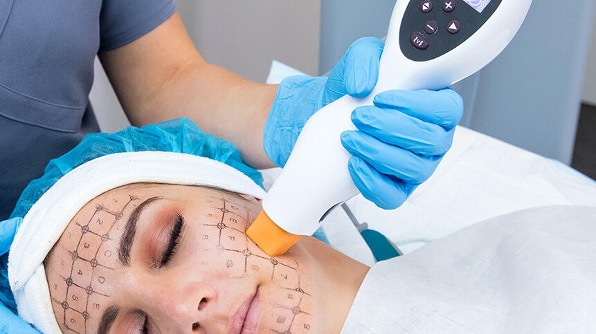Thermage® CPT™ Skin Tightening in Vancouver 3 What Areas Can Thermage® Treat? | EverYoung Skin Clinic