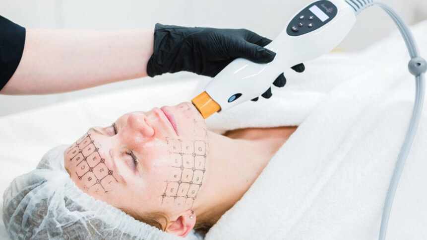 Thermage® CPT™ Skin Tightening in Vancouver 1 What is Thermage® CPT™? | EverYoung Skin Clinic Vancouver