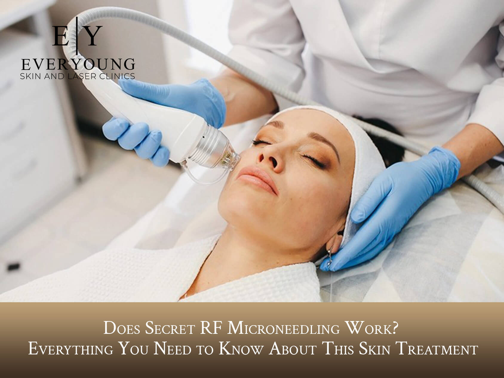 Does Secret RF Microneedling Work? Everything You Need to Know About This Skin Treatment | EverYoung