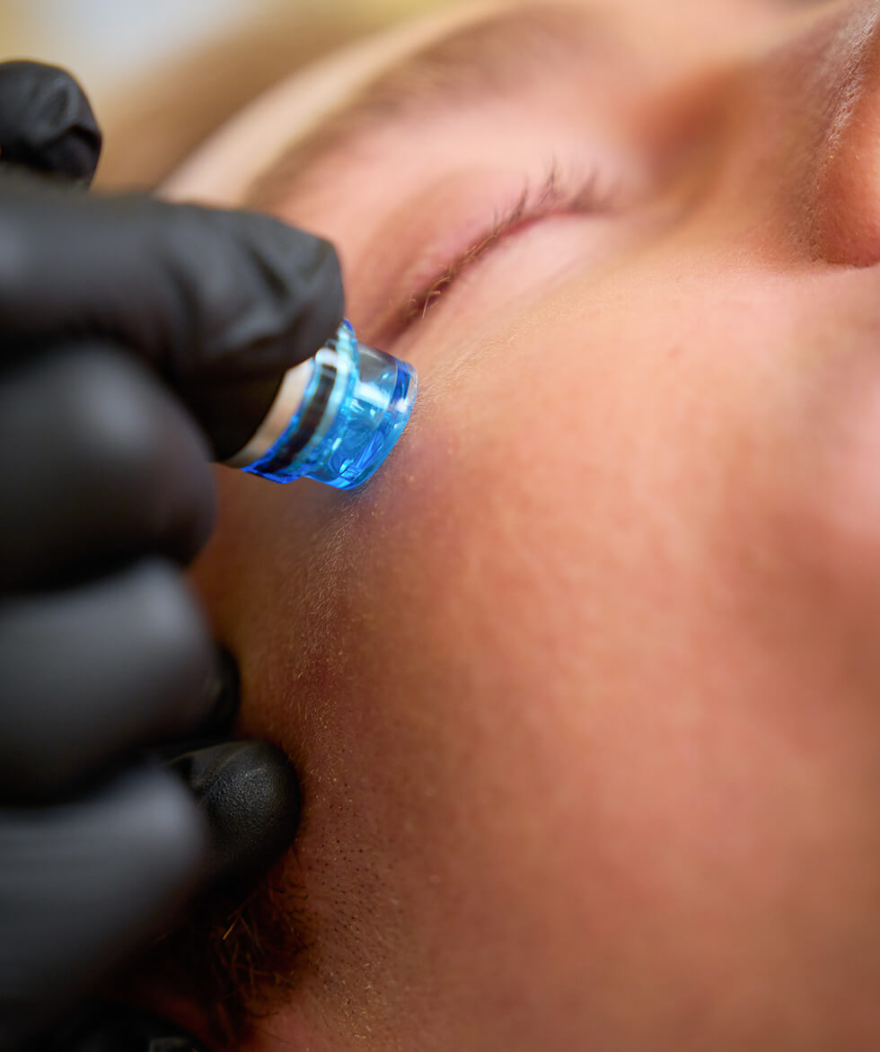 Sylfirm Treatment Vancouver | EverYoung Skin Care Clinic