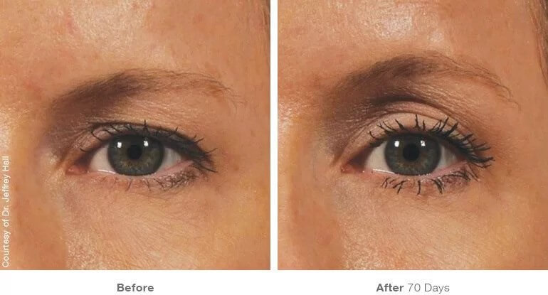 Ultherapy Vancouver | Before & After | EverYoung Skin Clinic