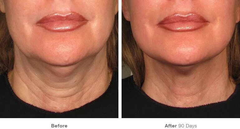 Ultherapy Neck Treatment Vancouver | Before & After | EverYoung Skin Clinic