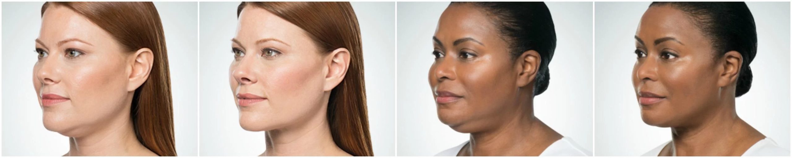 Belkyra Double Chin Removal | Before & After | EverYoung Skin Care Clinic