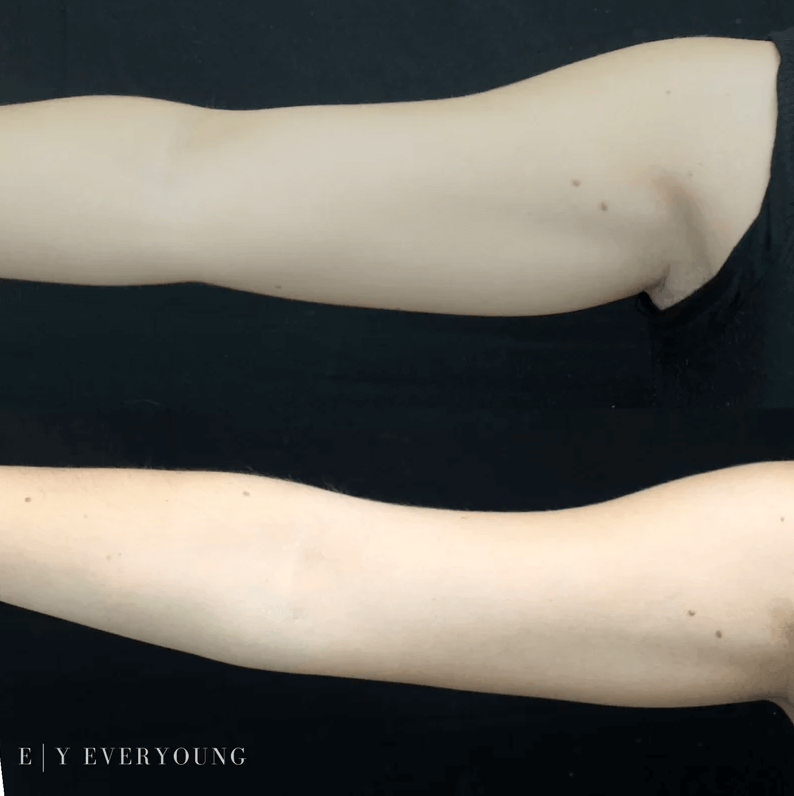 Coolsculpting - Before & After | EverYoung Skin Clinic Vancouver