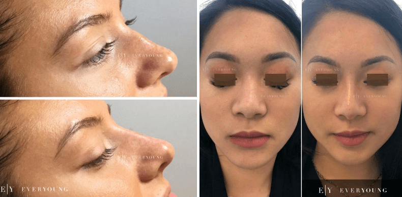 EverYoung Patient following nose bump slimming & correction | EverYoung