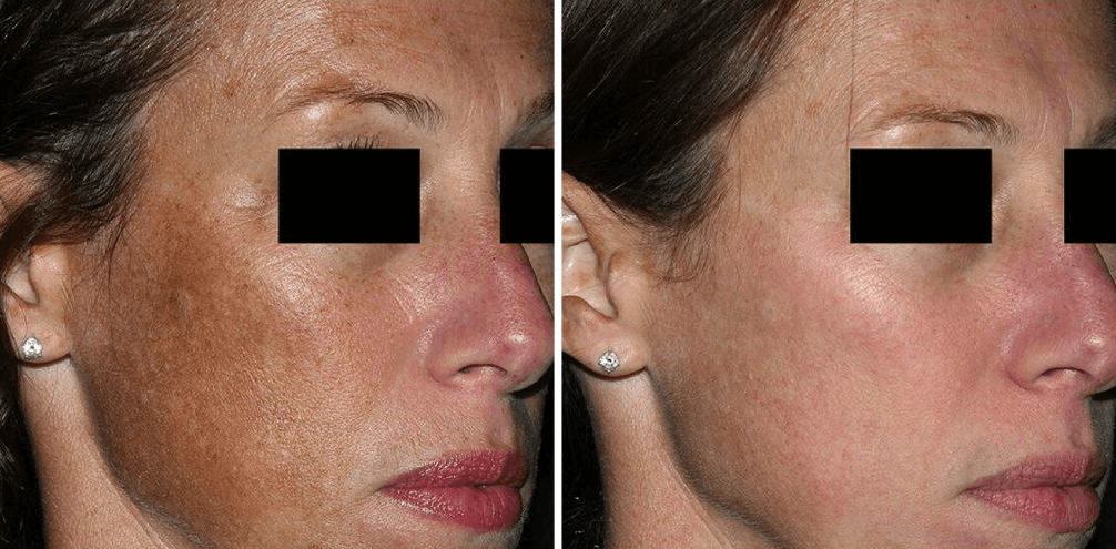 Sun damage and photo aging: before and after one PicoSure Focus treatment | EverYoung