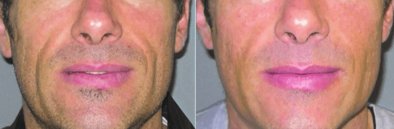 Bellafill® Acne Scar - Before & After 4 | EverYoung Skin Clinic