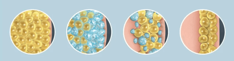 Coolsculpting Treatment Process | EverYoung Skin Clinic