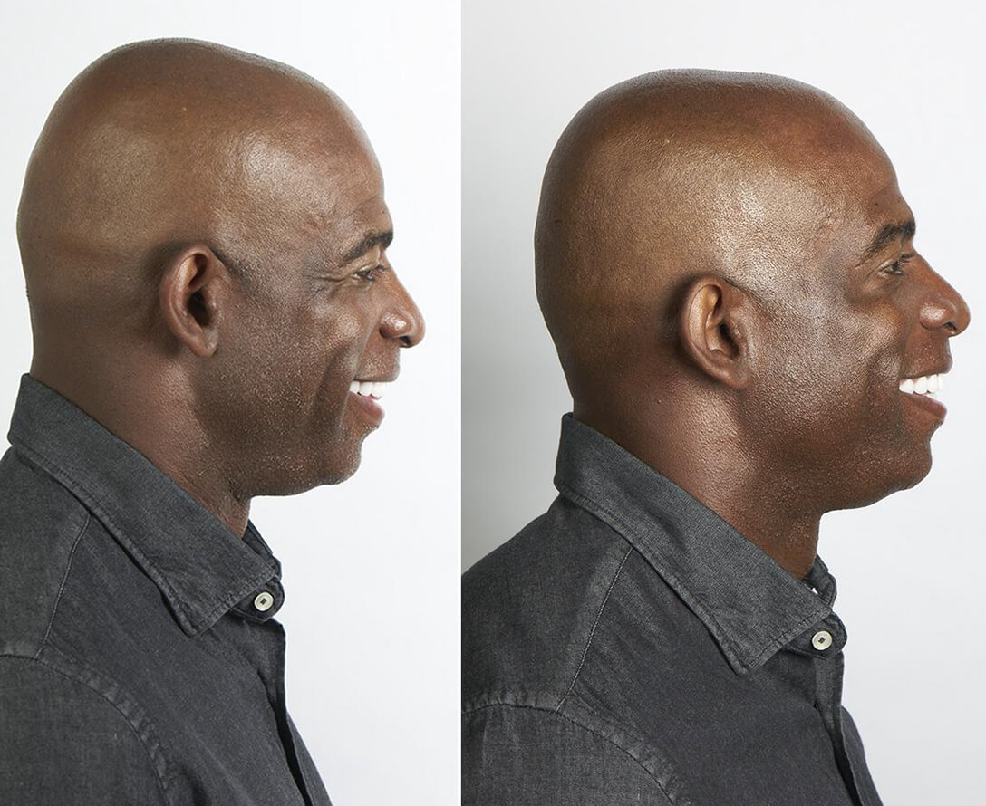 Celebrated Athlete Gets Botox at Age 50 | EverYoung Skin Care Clinic Vancouver