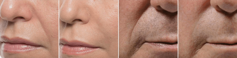 Dermal Fillers Vancouver | Before & After | EverYoung Skin Clinic