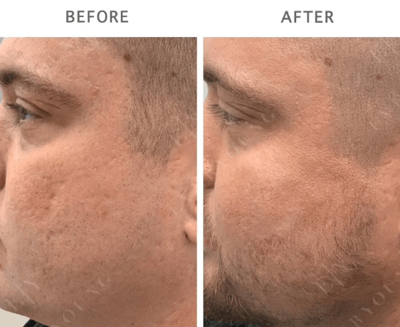Dermal Fillers Vancouver | Before & After | EverYoung Skin Clinic