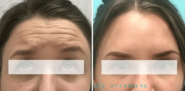 Forehead Botox Vancouver - Before & After | EverYoung Skin Clinic