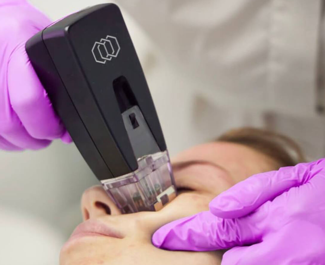 How Long Does Morpheus8 Last? | EverYoung Skin Care Clinic Vancouver