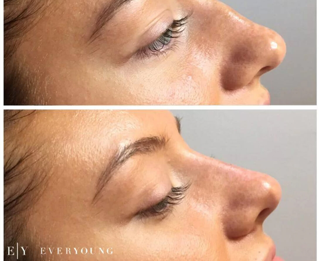Non-Surgical Rhinoplasty Before & After | EverYoung