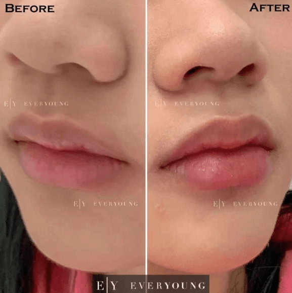 Lip Fillers Vancouver | Before & After | EverYoung Skin Clinic Vancouver