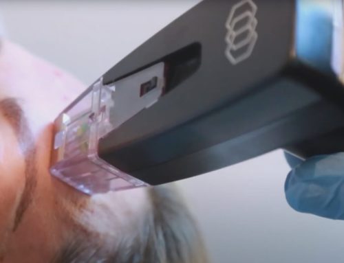 Differences Between Morpheus8 & Ultherapy