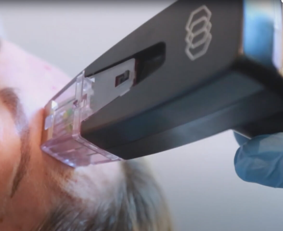 Differences Between Morpheus8 & Ultherapy | EverYoung Skin Care Clinic Vancouver