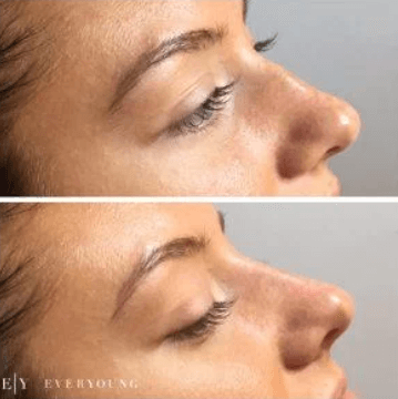 Non-Surgical Nose Job Before & After Results | EverYoung Skin Care Clinic