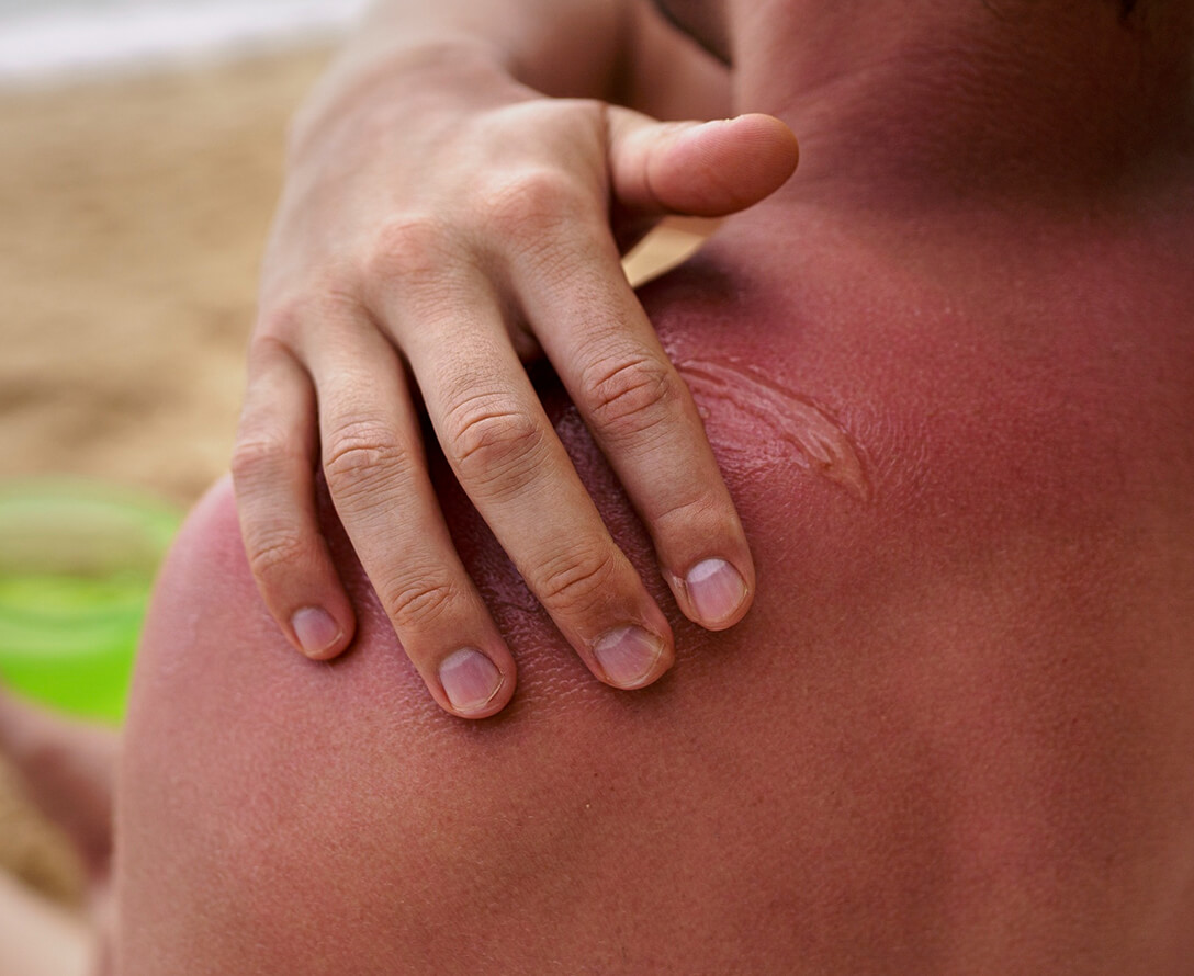Can You Reverse Sun Damage? | EverYoung Skin Care Clinic