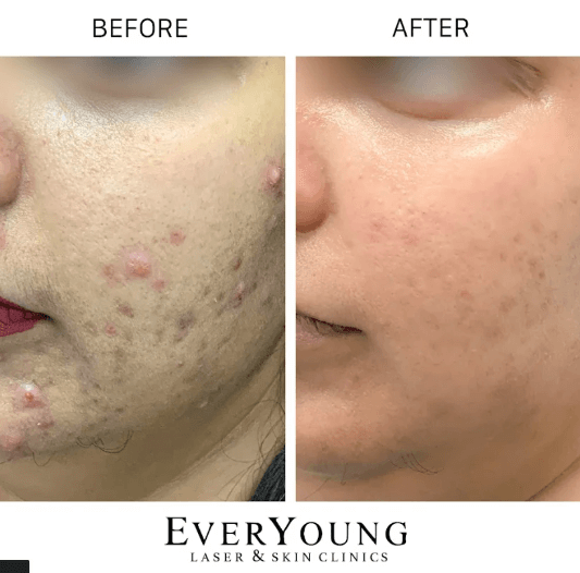 Acne Treatment | Before & After | EverYoung Skin Clinic Vancouver