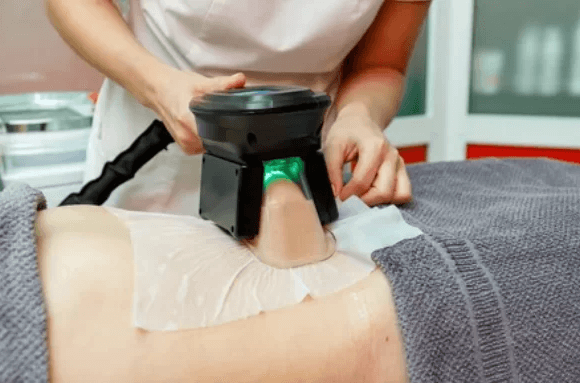 What is CoolSculpting? | EverYoung Skin Clinic Vancouver