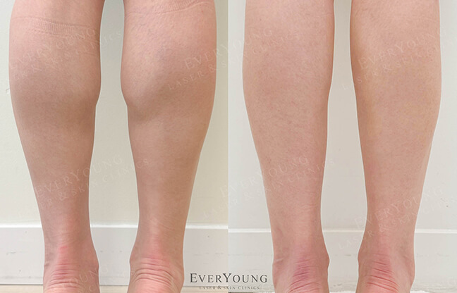 Calf Botox - Before & After Example 1 | EverYoung Skin Clinic Vancouver
