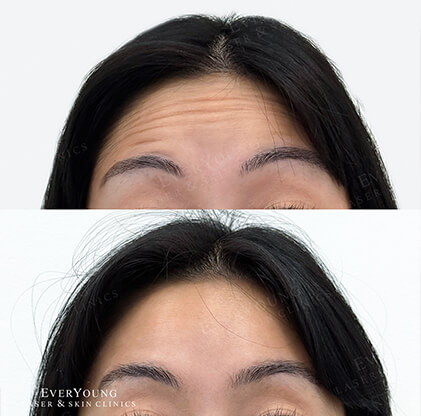 Botox - Before & After Example 2 | EverYoung Skin Clinic Vancouver