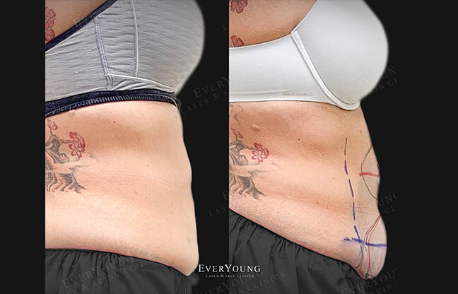 CoolSculpting & Fat Freezing - Before & After 1 | EverYoung Skin Clinic