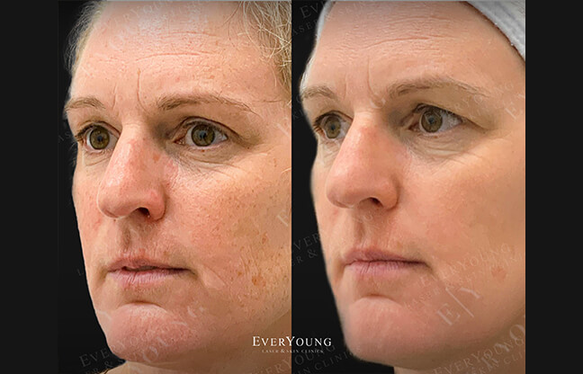 Super IPL Photo Facial Treatment - Before & After Results #1 | EverYoung Skin Clinic Vancouver
