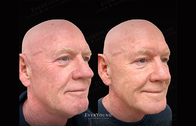 Super IPL Photo Facial Treatment - Before & After Results #2 | EverYoung Skin Clinic Vancouver
