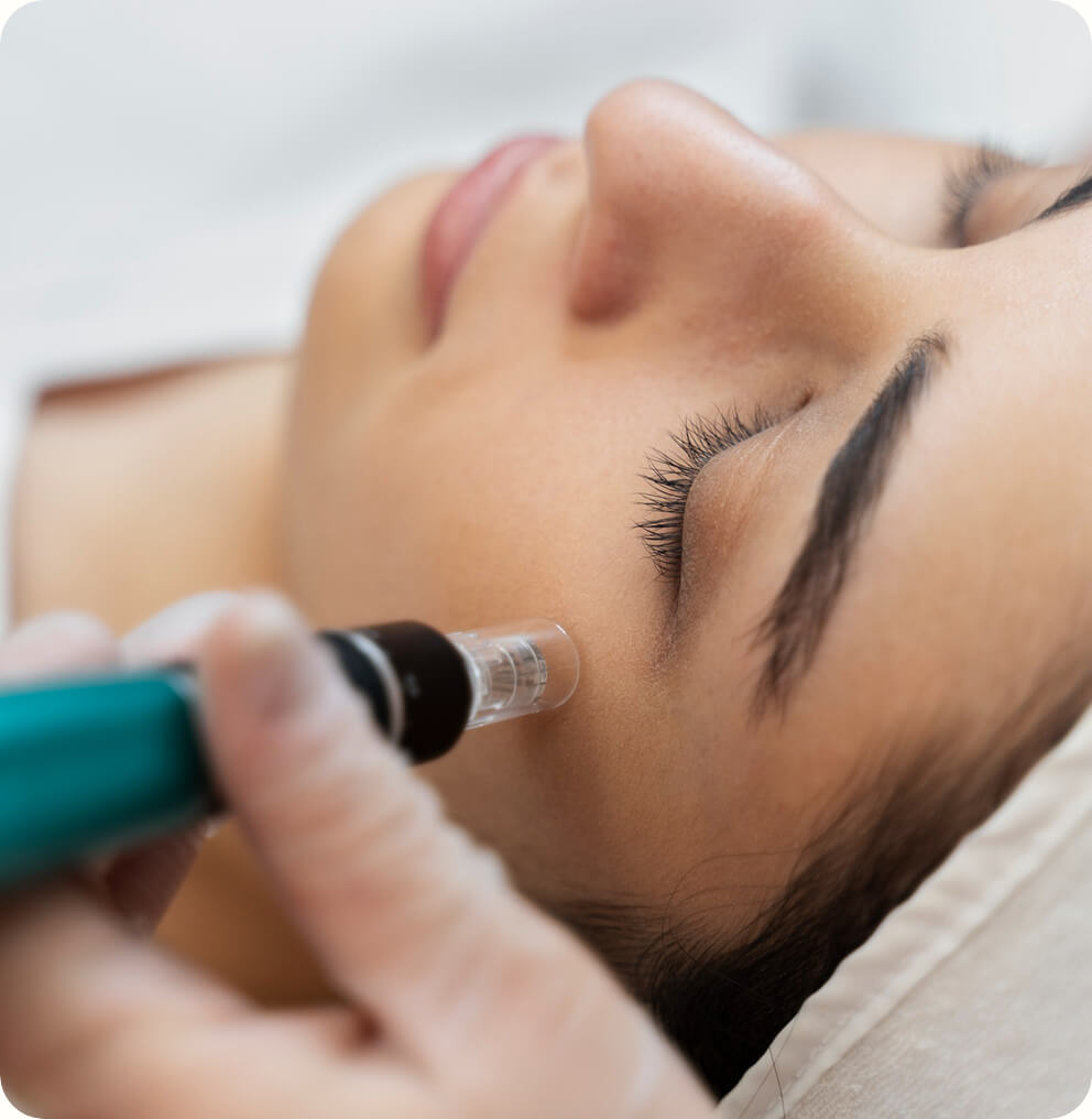Microneedling Treatment in Vancouver | EverYoung Skin Clinic