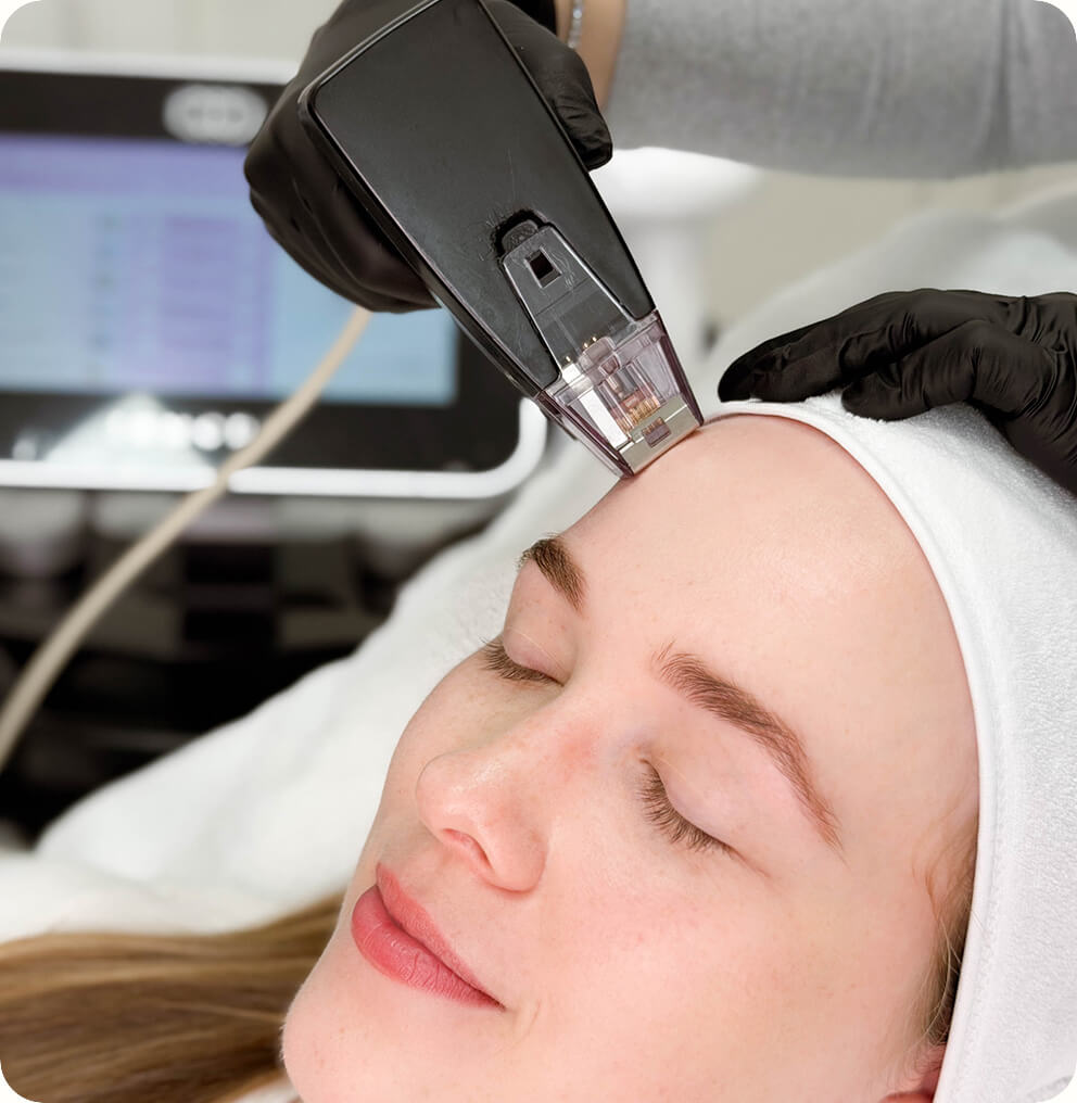 Morpheus8 Vancouver | EverYoung Skin Clinic