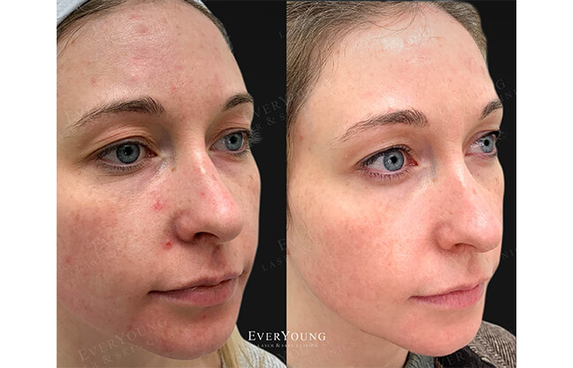 Secret™ RF Microneedling - Before & After 2 | EverYoung Skin Clinic Vancouver