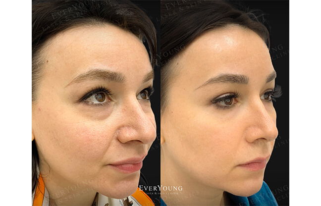 Secret™ RF Microneedling - Before & After 5 | EverYoung Skin Clinic Vancouver