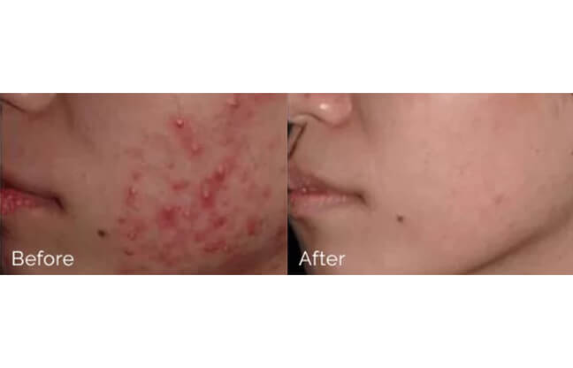 Chemical Peels - Before & After Treatment 1 | EverYoung Skin Clinic