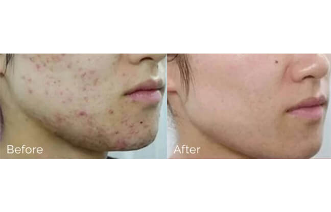 Chemical Peels - Before & After Treatment 2 | EverYoung Skin Clinic