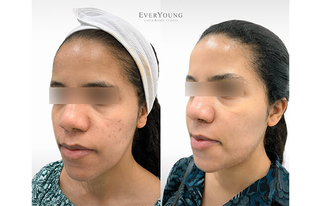 Fractional Skin Resurfacing - Before & After 1 | EverYoung Skin Clinic