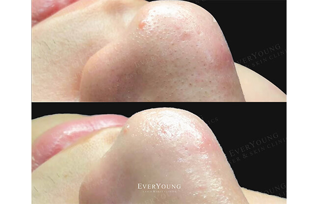 HydraFacial MD® Treatment - Before & After 3 | EverYoung Skin Clinic