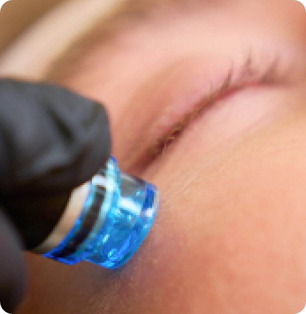 HydraFacial MD® Vancouver | EverYoung Skin Clinic