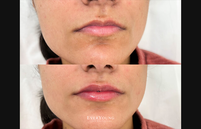 Lip Fillers in Vancouver - Before & After 3 | EverYoung Skin Clinic